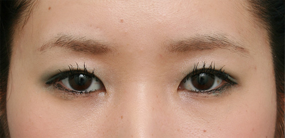 症例写真,二重まぶた・全切開法の症例 まぶたに脂肪が多く腫れぼったい目だった女性,After（メイクあり）<br/>
（3ヶ月後）,