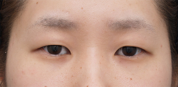 症例写真,二重まぶた・全切開法の症例 まぶたに脂肪が多く腫れぼったい目だった女性,Before,ba_sekkai07_b.jpg