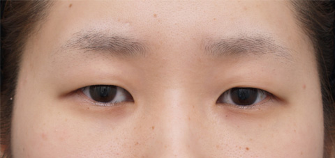 症例写真,二重まぶた・全切開法の症例 まぶたに脂肪が多く腫れぼったい目だった女性,手術前,mainpic_sekkai02a.jpg