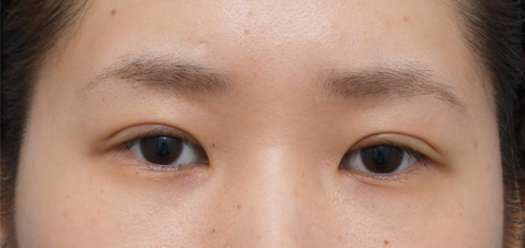 症例写真,二重まぶた・全切開法の症例 まぶたに脂肪が多く腫れぼったい目だった女性,手術直後,mainpic_sekkai02b.jpg
