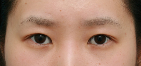 症例写真,二重まぶた・全切開法の症例 まぶたに脂肪が多く腫れぼったい目だった女性,3ヶ月後,メイクなし,mainpic_sekkai02c.jpg