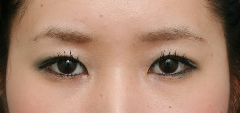 症例写真,二重まぶた・全切開法の症例 まぶたに脂肪が多く腫れぼったい目だった女性,3ヶ月後,メイクあり,mainpic_sekkai02d.jpg