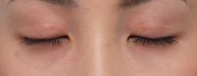 症例写真,二重まぶた・全切開法の症例 まぶたの上に不自然なクセができていた女性,6ヶ月後,目を閉じた状態,mainpic_sekkai06e.jpg