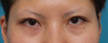 二重まぶた・全切開法,片目ずつ全切開二重手術をした症例写真,After3週間開けて片目ずつ手術（メイクなし）,ba_sekkai15_a01.jpg