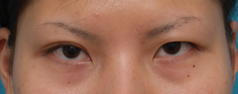 症例写真,片目ずつ全切開二重手術をした症例写真,右目術後3週間,mainpic_sekkai09d.jpg