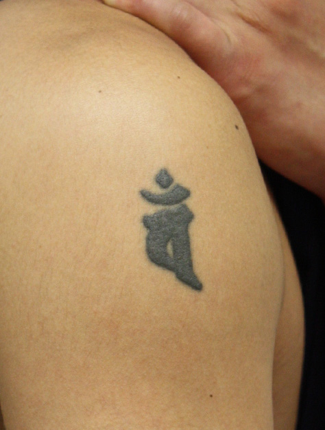 刺青（タトゥー）除去の症例 切除縫縮にて除去、抜糸直後の状態,Before,ba_irezumi11_b.jpg