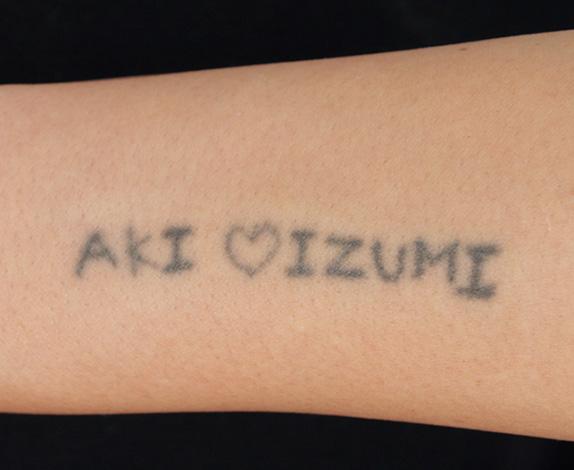 刺青（タトゥー）除去,入れ墨の切除縫縮の症例,Before,ba_irezumi09_b.jpg