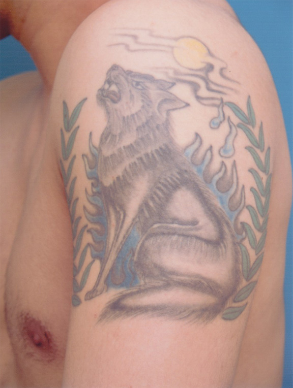刺青（タトゥー）除去,肩の大きな入れ墨の剥削手術症例写真,Before,ba_irezumi12_b.jpg