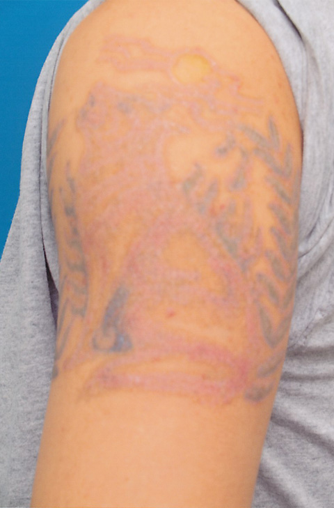 刺青（タトゥー）除去,肩の大きな入れ墨の剥削手術症例写真,レーザー治療4回終了後,mainpic_irezumi08b.jpg