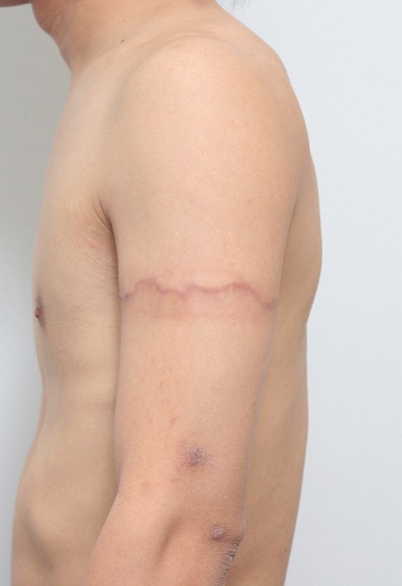二の腕の刺青を2回に分けて切除縫縮した症例写真,After2回目手術後3ヶ月,ba_irezumi16_a01.jpg
