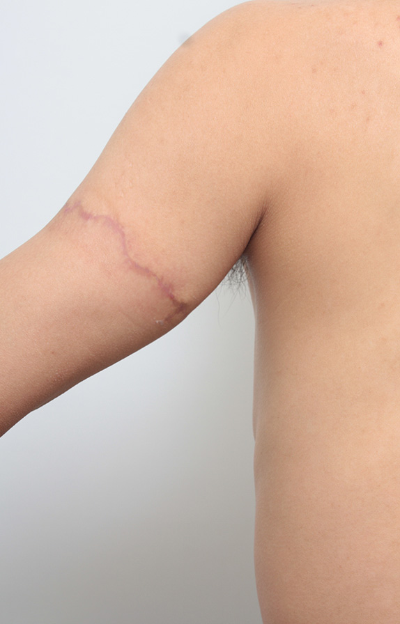 刺青（タトゥー）除去,二の腕の刺青を2回に分けて切除縫縮した症例写真,After2回目手術後3ヶ月,ba_irezumi18_b.jpg