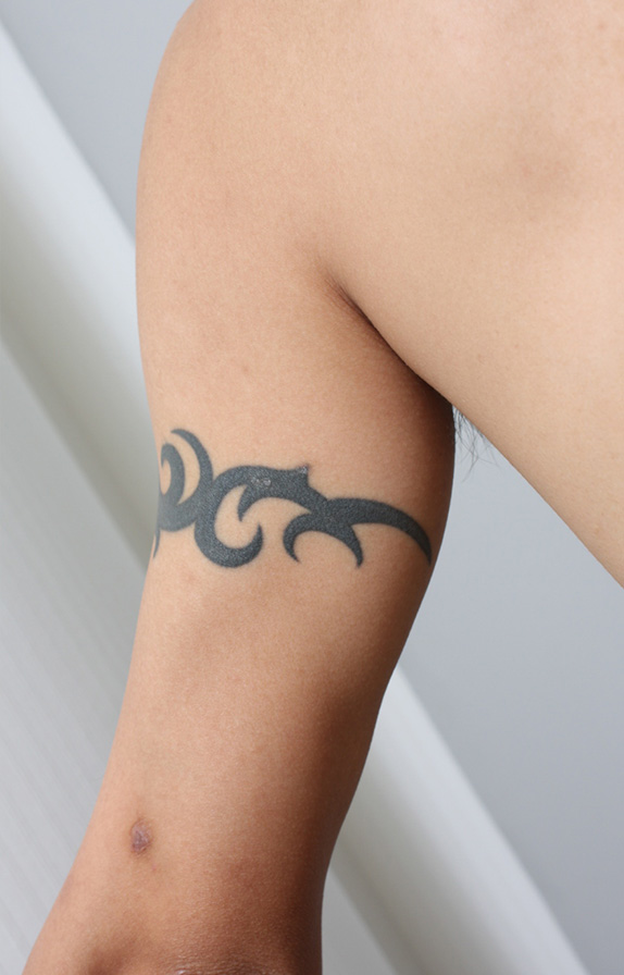 刺青（タトゥー）除去,二の腕の刺青を2回に分けて切除縫縮した症例写真,Before,ba_irezumi18_b.jpg