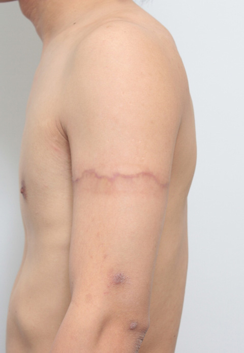 刺青（タトゥー）除去,二の腕の刺青を2回に分けて切除縫縮した症例写真,2回目手術後（3ヶ月）,mainpic_irezumi05d.jpg