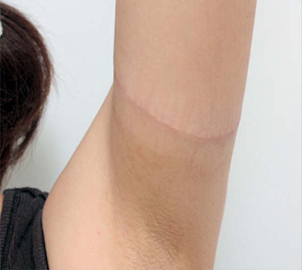 刺青（タトゥー）除去,二の腕の入れ墨切除縫縮した症例写真,After,ba_irezumi19_a01.jpg