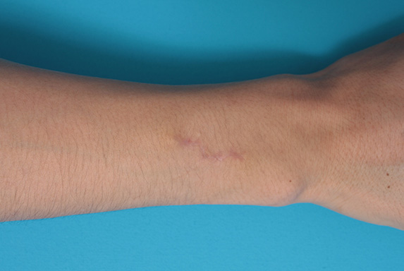 刺青（タトゥー）除去,入れ墨の切除縫縮の症例写真,After(3ヶ月後),ba_irezumi20_a01.jpg