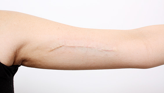 刺青（タトゥー）除去,2回に分けて切除縫縮した二の腕の入れ墨の症例写真,After,ba_irezumi13_b.jpg