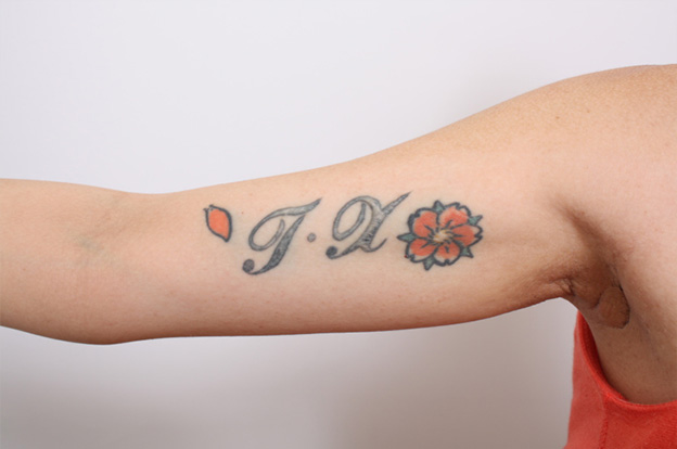 刺青（タトゥー）除去,2回に分けて切除縫縮した二の腕の入れ墨の症例写真,Before,ba_irezumi21_b.jpg