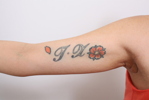 刺青（タトゥー）除去,2回に分けて切除縫縮した二の腕の入れ墨の症例写真,手術前,mainpic_irezumi07a.jpg