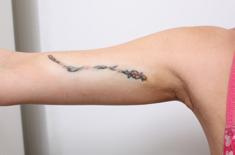 刺青（タトゥー）除去,2回に分けて切除縫縮した二の腕の入れ墨の症例写真,1回目手術直後,mainpic_irezumi07b.jpg