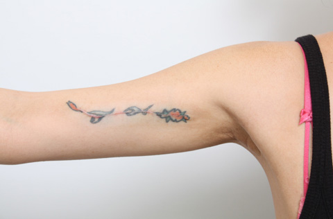 刺青（タトゥー）除去,2回に分けて切除縫縮した二の腕の入れ墨の症例写真,1回目手術後3ヶ月,mainpic_irezumi07c.jpg