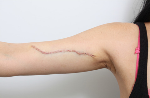 刺青（タトゥー）除去,2回に分けて切除縫縮した二の腕の入れ墨の症例写真,2回目手術直後,mainpic_irezumi07d.jpg