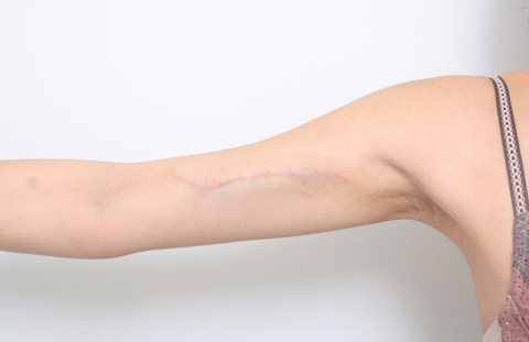 刺青（タトゥー）除去,2回に分けて切除縫縮した二の腕の入れ墨の症例写真,2回目手術後6ヶ月,mainpic_irezumi07e.jpg