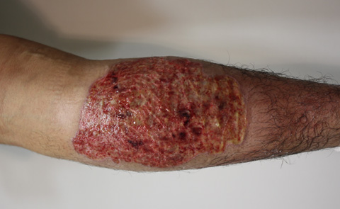 刺青（タトゥー）除去,巨大なふくらはぎの刺青を剥削手術で完全除去した症例写真,1週間後,mainpic_irezumi10c.jpg