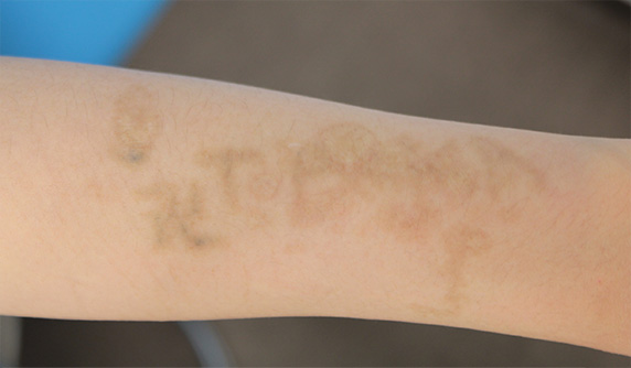 刺青（タトゥー）除去,自分で入れた墨汁の入れ墨をレーザーで消した症例写真,After（3ヶ月後）,ba_irezumi24_a01.jpg