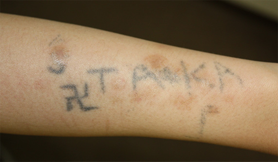 刺青（タトゥー）除去,自分で入れた墨汁の入れ墨をレーザーで消した症例写真,Before,ba_irezumi24_b.jpg