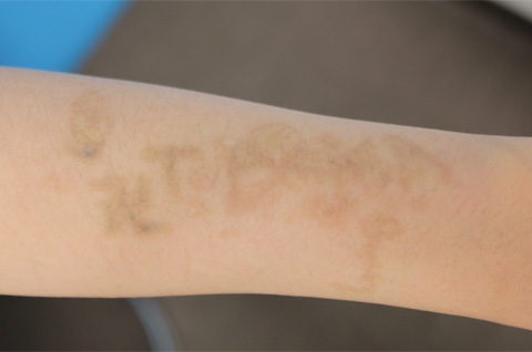 刺青（タトゥー）除去,自分で入れた墨汁の入れ墨をレーザーで消した症例写真,3ヶ月後,mainpic_irezumi11c.jpg
