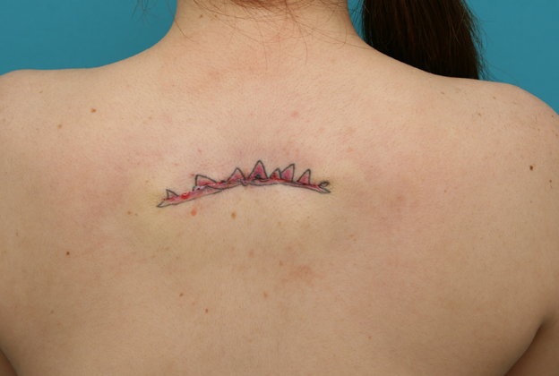 刺青（タトゥー）除去,背中の入れ墨を2回に分けて切除縫縮した症例写真,1回目手術直後,mainpic_irezumi12b.jpg