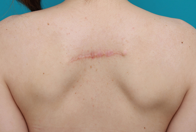 刺青（タトゥー）除去,背中の入れ墨を2回に分けて切除縫縮した症例写真,2回目手術後6ヶ月,mainpic_irezumi12f.jpg