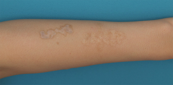 刺青（タトゥー）除去,腕に墨汁で入れた刺青にレーザー治療した症例写真,After（3回目照射後2ヶ月）,ba_irezumi26_b.jpg