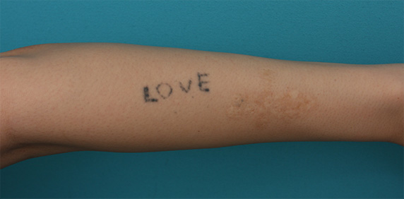 腕に墨汁で入れた刺青にレーザー治療した症例写真,Before,ba_irezumi26_b.jpg