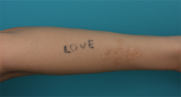 刺青（タトゥー）除去,腕に墨汁で入れた刺青にレーザー治療した症例写真,治療前,mainpic_irezumi13a.jpg