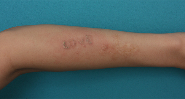 刺青（タトゥー）除去,腕に墨汁で入れた刺青にレーザー治療した症例写真,2回目治療直後,mainpic_irezumi13d.jpg