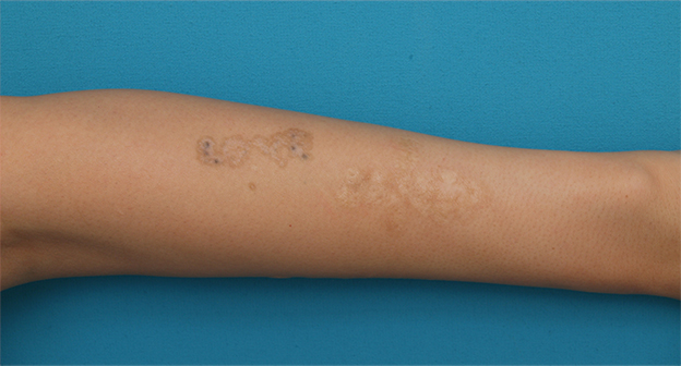 刺青（タトゥー）除去,腕に墨汁で入れた刺青にレーザー治療した症例写真,2回目照射後2ヶ月,mainpic_irezumi13e.jpg