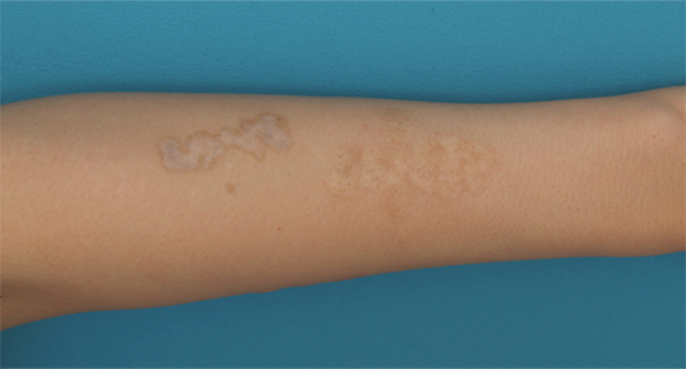 刺青（タトゥー）除去,腕に墨汁で入れた刺青にレーザー治療した症例写真,3回目照射後2ヶ月,mainpic_irezumi13f.jpg