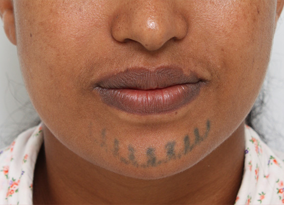 刺青（タトゥー）除去,アフリカの黒人女性の顔面の入れ墨にレーザー治療した症例写真,Before,ba_irezumi27_b.jpg