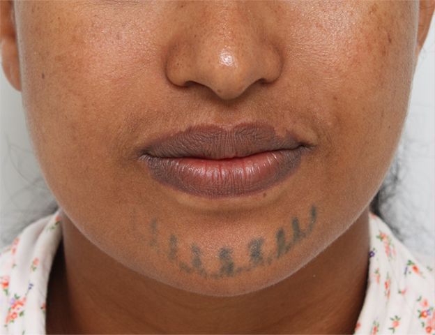 刺青（タトゥー）除去,アフリカの黒人女性の顔面の入れ墨にレーザー治療した症例写真,治療前,mainpic_irezumi14a.jpg