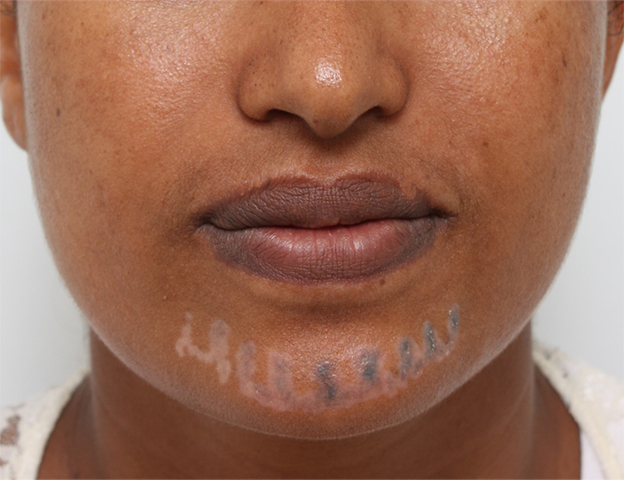 刺青（タトゥー）除去,アフリカの黒人女性の顔面の入れ墨にレーザー治療した症例写真,1回目照射後1週間,mainpic_irezumi14c.jpg