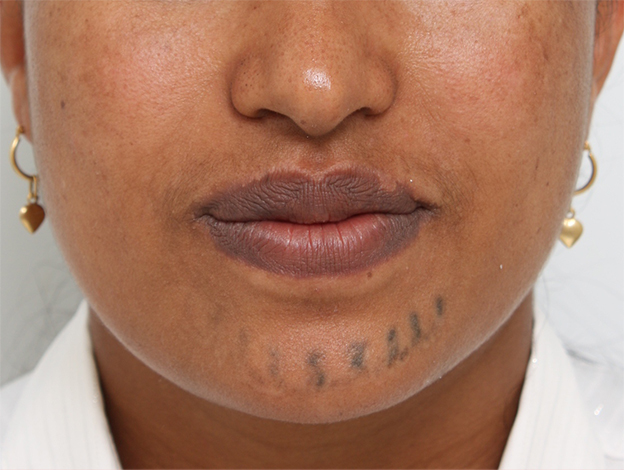 刺青（タトゥー）除去,アフリカの黒人女性の顔面の入れ墨にレーザー治療した症例写真,1回目照射後2ヶ月,mainpic_irezumi14d.jpg