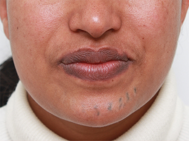 刺青（タトゥー）除去,アフリカの黒人女性の顔面の入れ墨にレーザー治療した症例写真,2回目照射後2ヶ月,mainpic_irezumi14f.jpg
