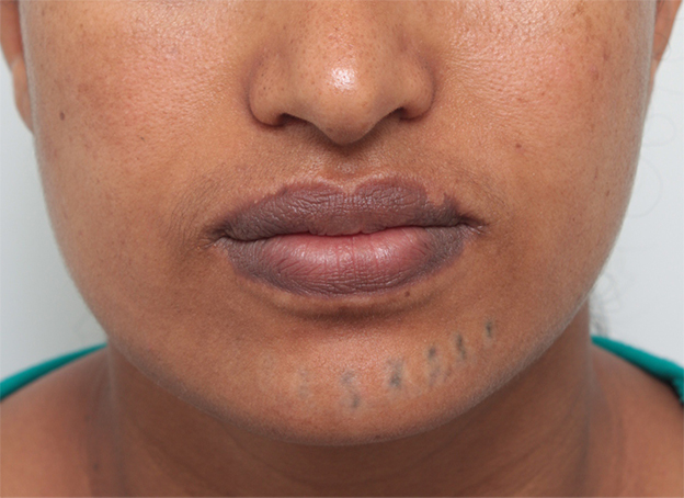 刺青（タトゥー）除去,アフリカの黒人女性の顔面の入れ墨にレーザー治療した症例写真,3回目照射後2ヶ月,mainpic_irezumi14g.jpg