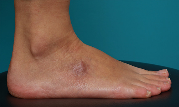 刺青（タトゥー）除去,足の小さな入れ墨を剥削手術で除去した症例写真,After（6ヶ月後）,ba_irezumi28_a01.jpg