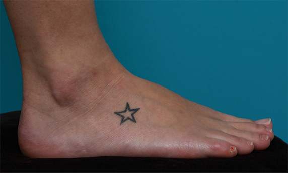 刺青（タトゥー）除去,足の小さな入れ墨を剥削手術で除去した症例写真,Before,ba_irezumi28_b.jpg