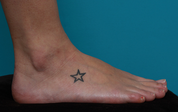 刺青（タトゥー）除去,足の小さな入れ墨を剥削手術で除去した症例写真,手術前,mainpic_irezumi15a.jpg