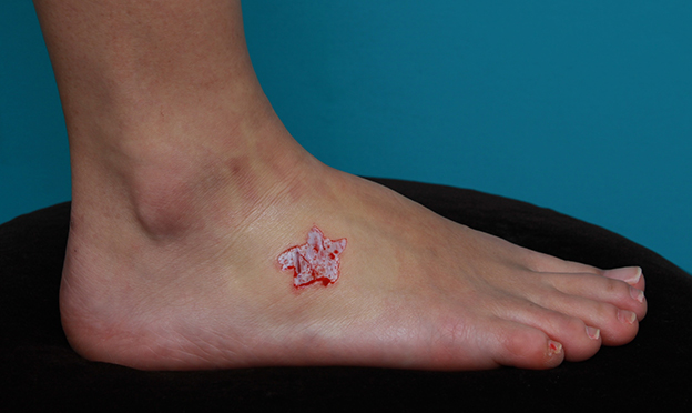 刺青（タトゥー）除去,足の小さな入れ墨を剥削手術で除去した症例写真,手術直後,mainpic_irezumi15b.jpg