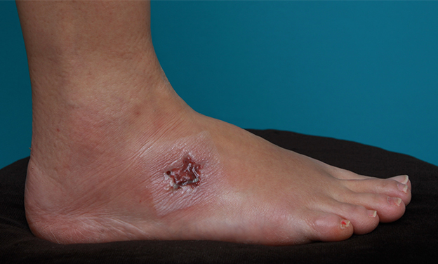 刺青（タトゥー）除去,足の小さな入れ墨を剥削手術で除去した症例写真,1週間後,mainpic_irezumi15c.jpg