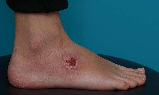 刺青（タトゥー）除去,足の小さな入れ墨を剥削手術で除去した症例写真,2週間後,mainpic_irezumi15d.jpg